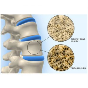 Osteoporosi en persones joves